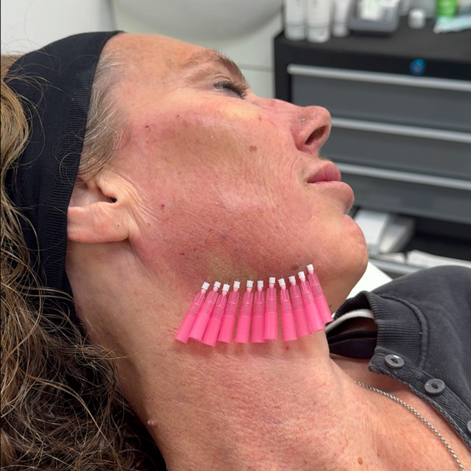 monothreads-procedure monothreads procedure