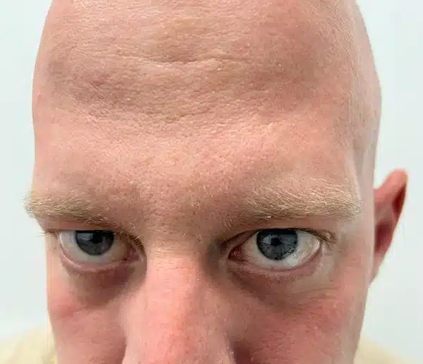 After-facefive