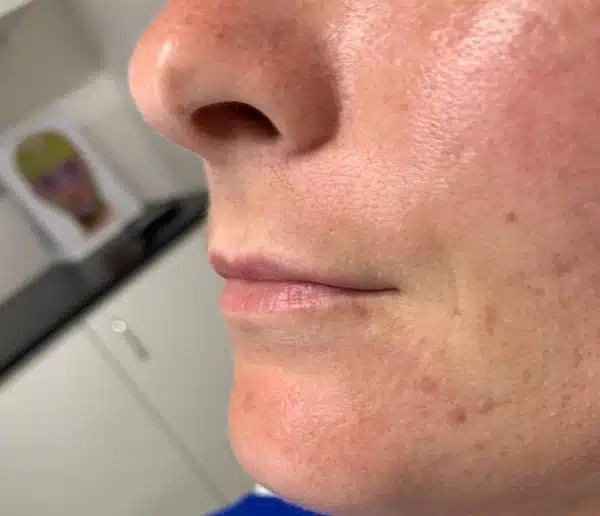 Before-facetwo