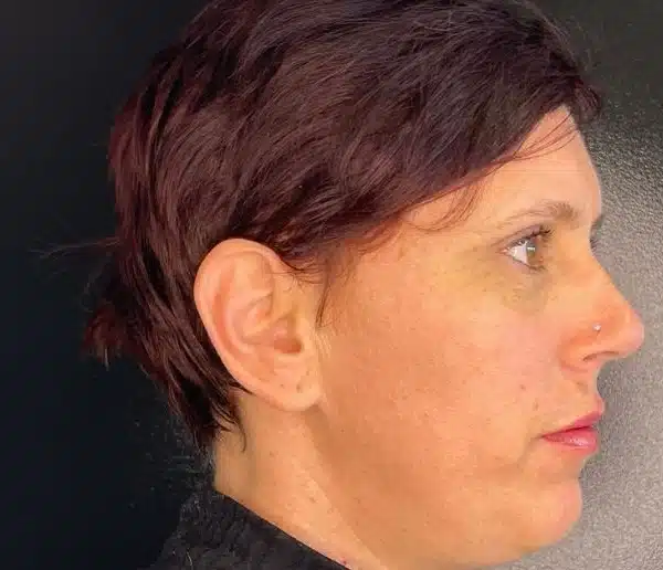 After-facefour