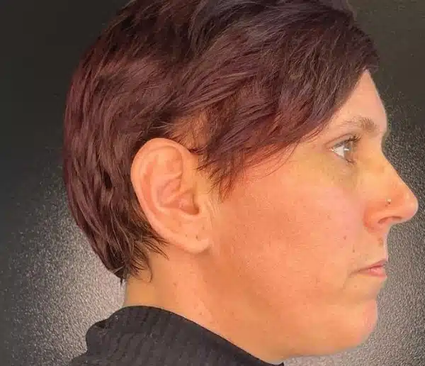 Before-facefour