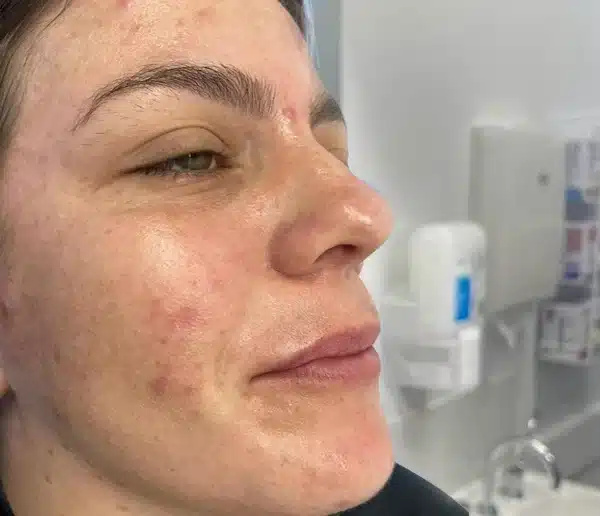 Before-hand