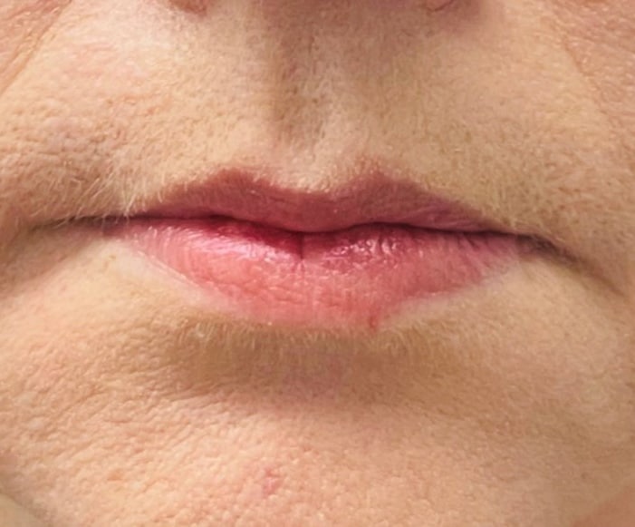 After-Peri-oral treatment