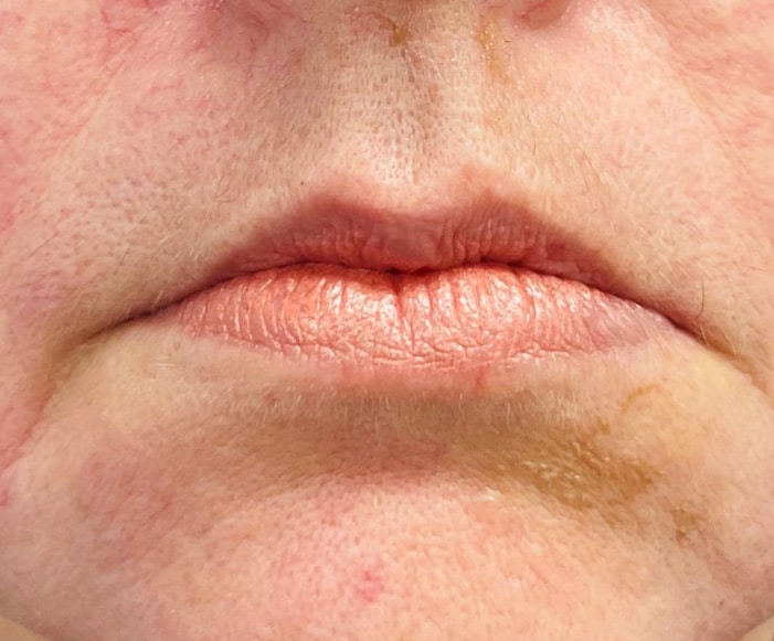 Before-Peri-oral treatment