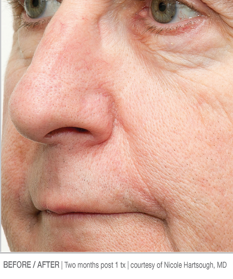 After-After 1 treatments