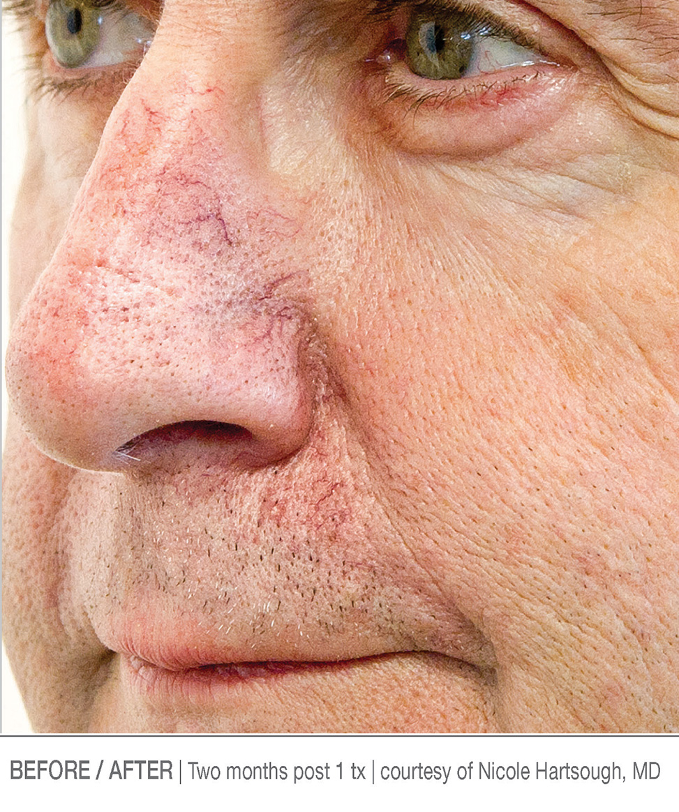 Before-After 1 treatments